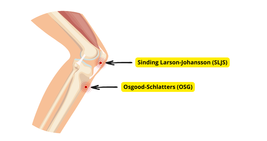 Knäled med markerade smärtpunkter vid schlatters sjukdom