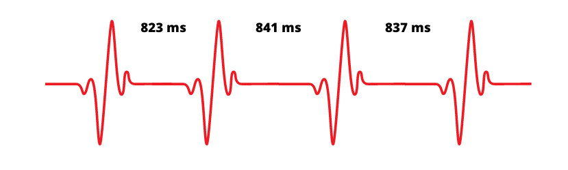 Variabelt mellanrum mellan pulsslag - hrv