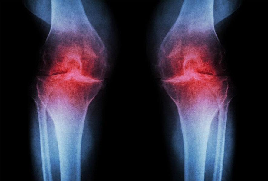 En röntgenbild som visar en knäled med artros.