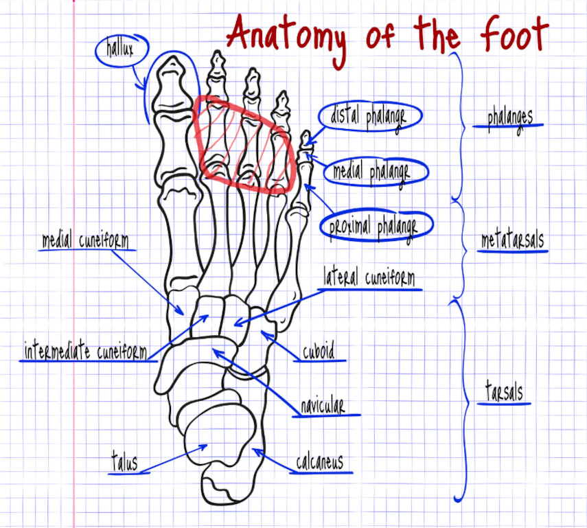 Schematisk bild över fotens anatomi med mortons neurom markerat i rött