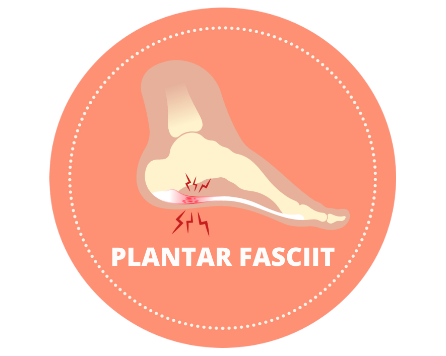 Plantar Fasciit, visar var smärtan sitter under foten