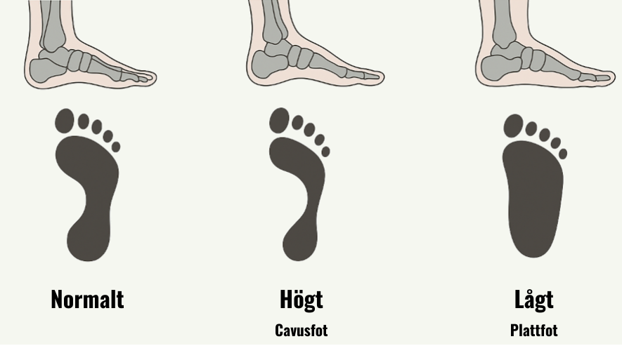 Illustration som visar tre olika typer av fotavtryck, från vänster till höger syns normalt, högt fotvalv (cavusfot) och lågt fotvalv (plattfot)